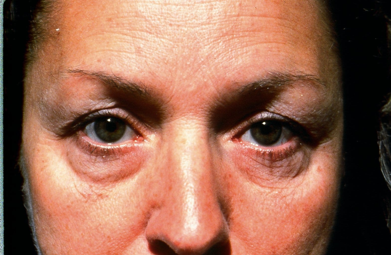 Blepharoplasty eyelid surgery Before