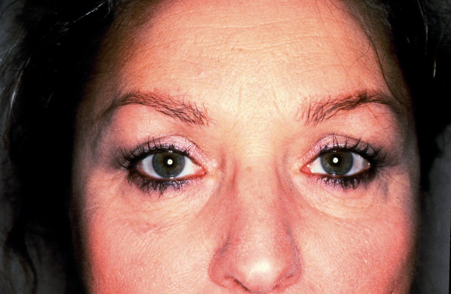 Blepharoplasty eyelid surgery after