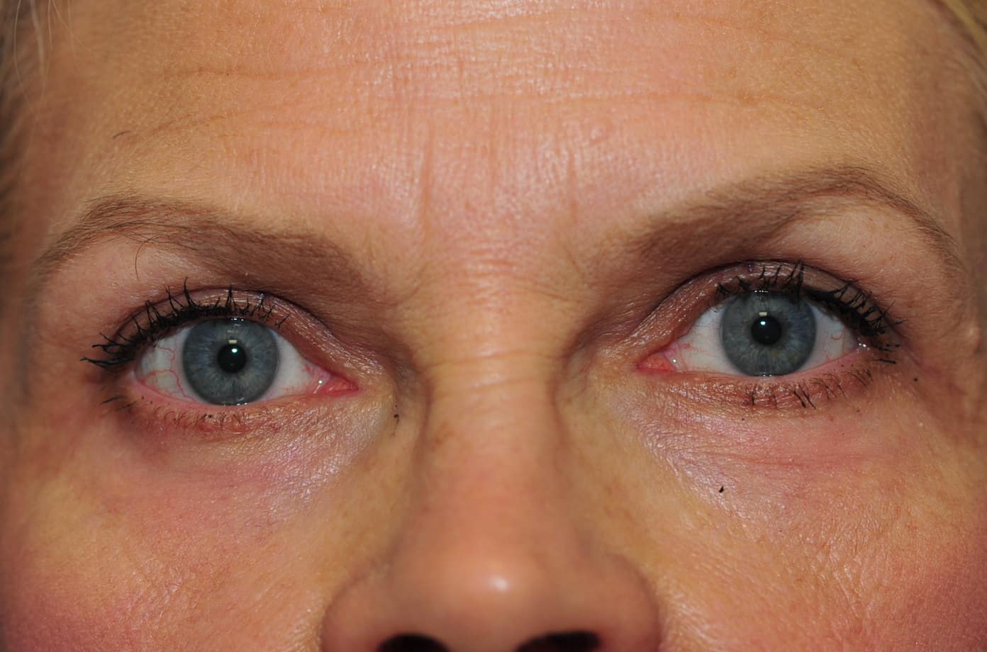 Blepharoplasty eyelid surgery after