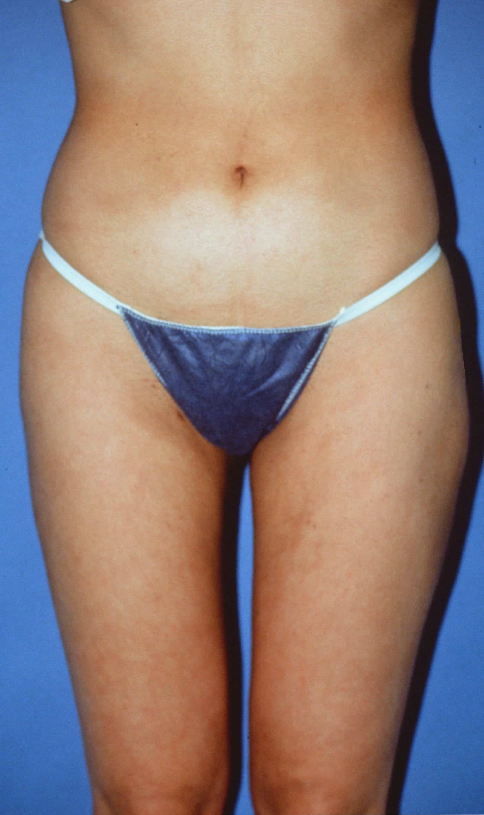 Liposuction body after