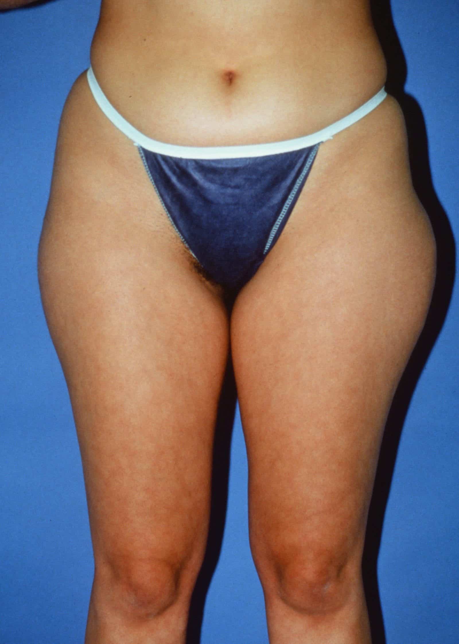 Liposuction body before