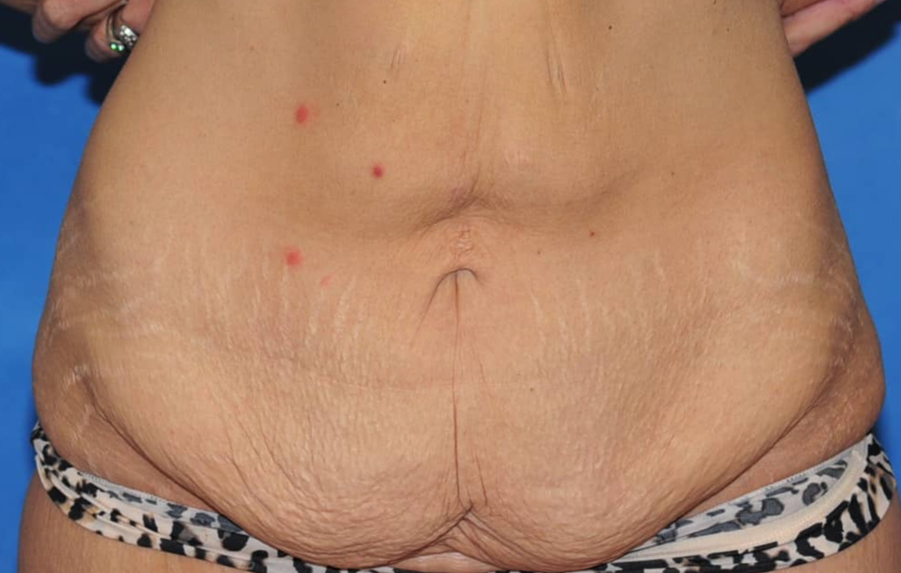 Liposuction face before
