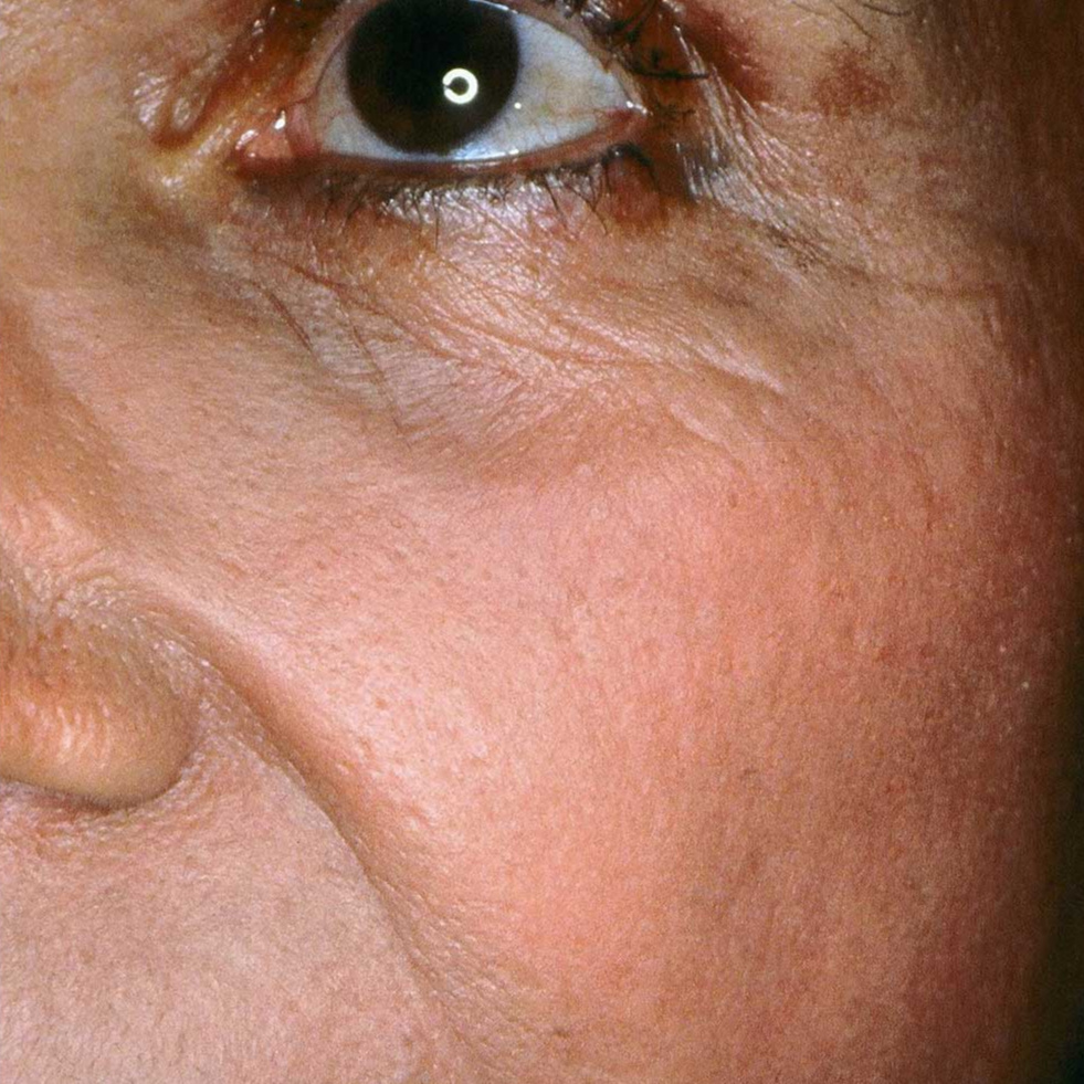 blonde woman facelift after 