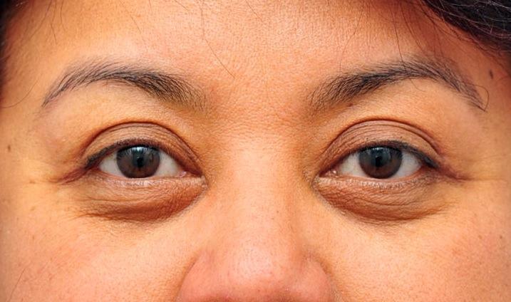 woman who had laser eyelid surgery - after surgery picture