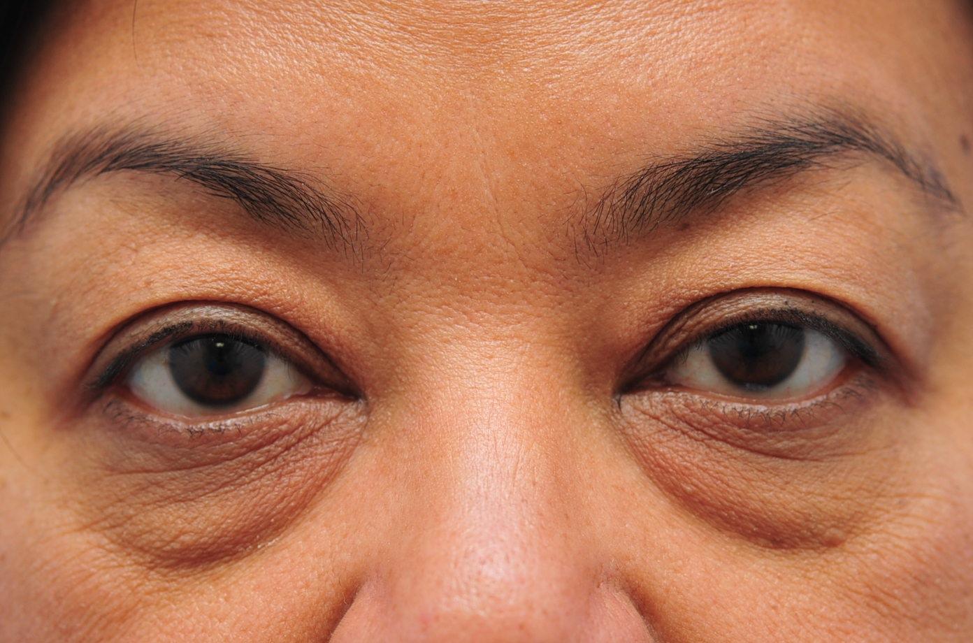 woman pre-laser eyelid surgery - before surgery picture